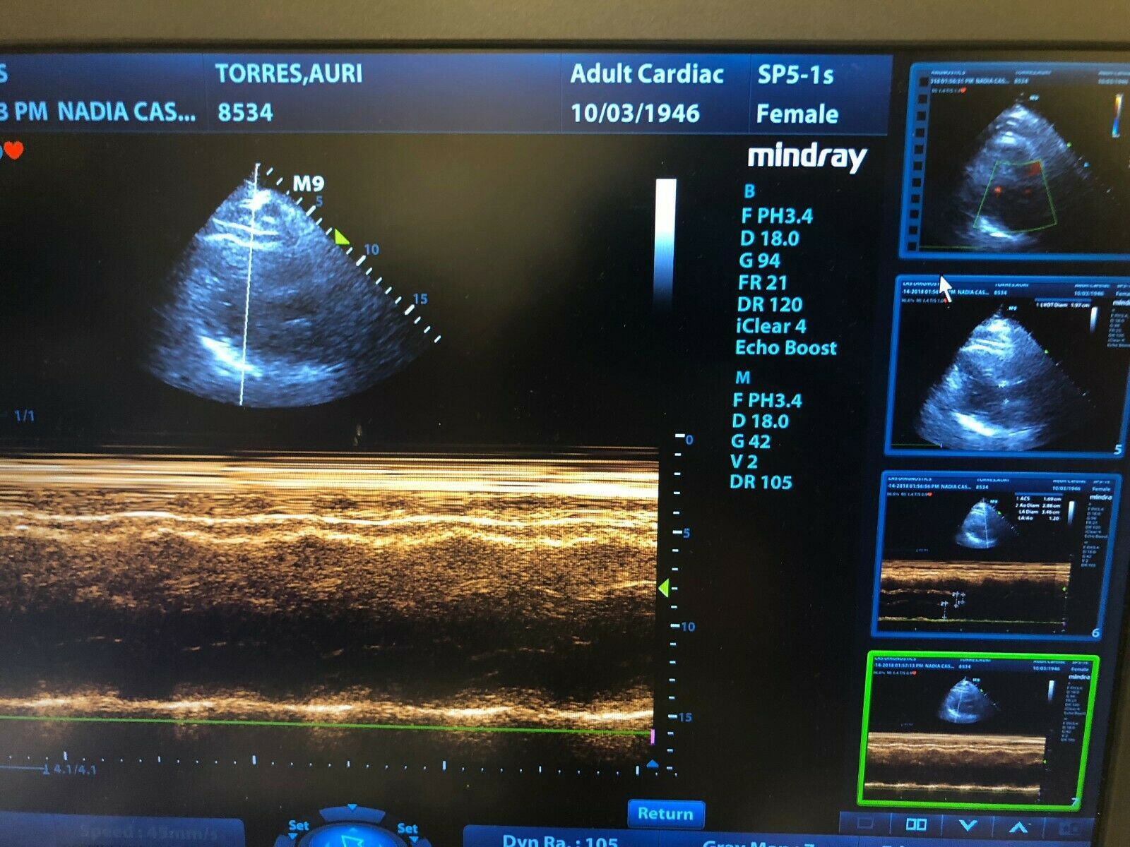 Mindray M9 Portable Ultrasound With Two Probes (L12-4S) (C5-1S) DOM 2015 DIAGNOSTIC ULTRASOUND MACHINES FOR SALE
