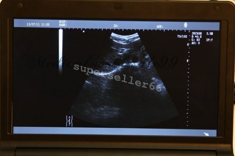 Digital LCD Ultrasound Scanner B Ultrasonic Machine,Convex Probe ,Linear Probe DIAGNOSTIC ULTRASOUND MACHINES FOR SALE