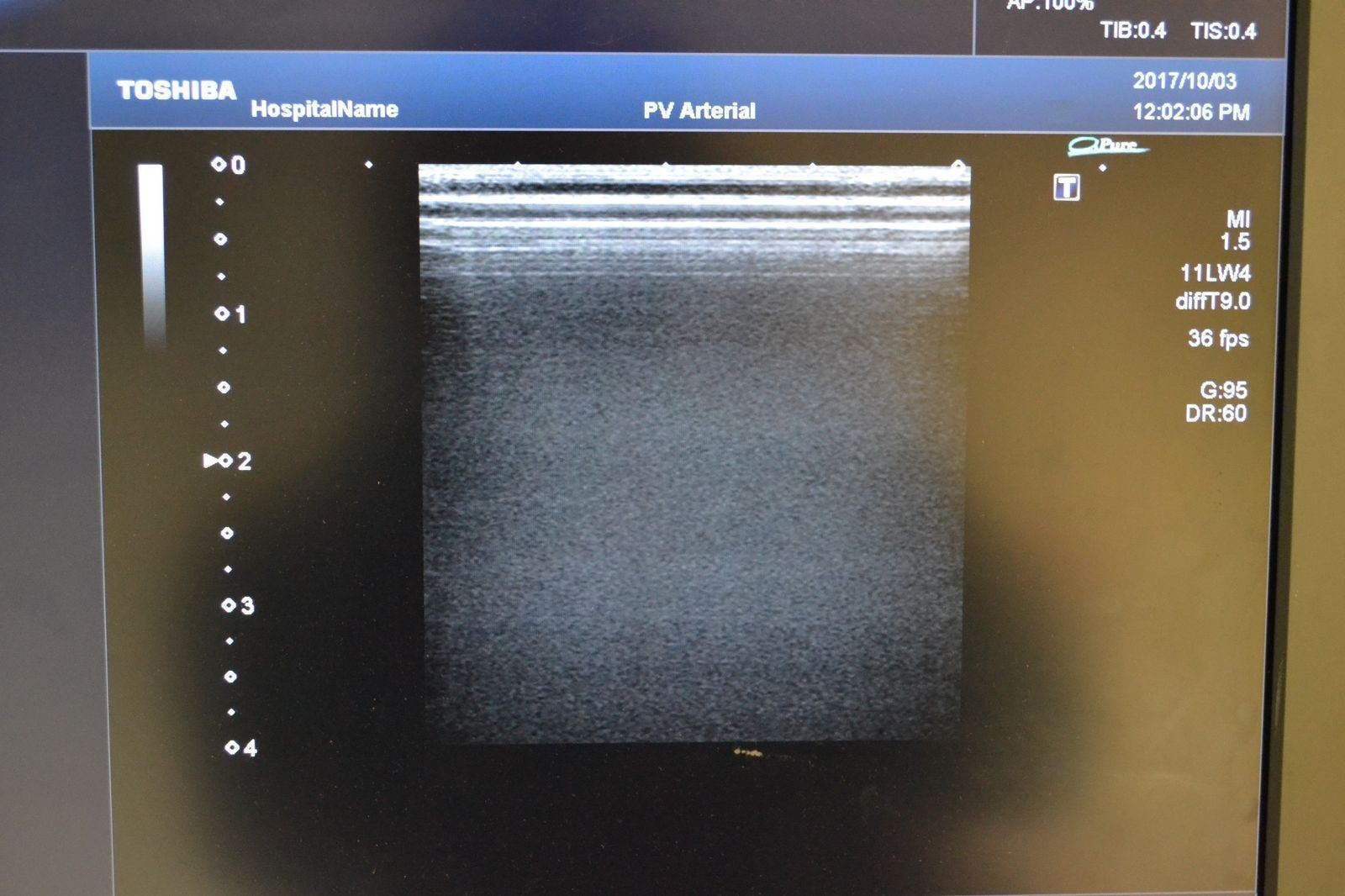Toshiba Artida PLT-704SBT 11-4.8MHz Linear Ultrasound Transducer Probe J1629 DIAGNOSTIC ULTRASOUND MACHINES FOR SALE