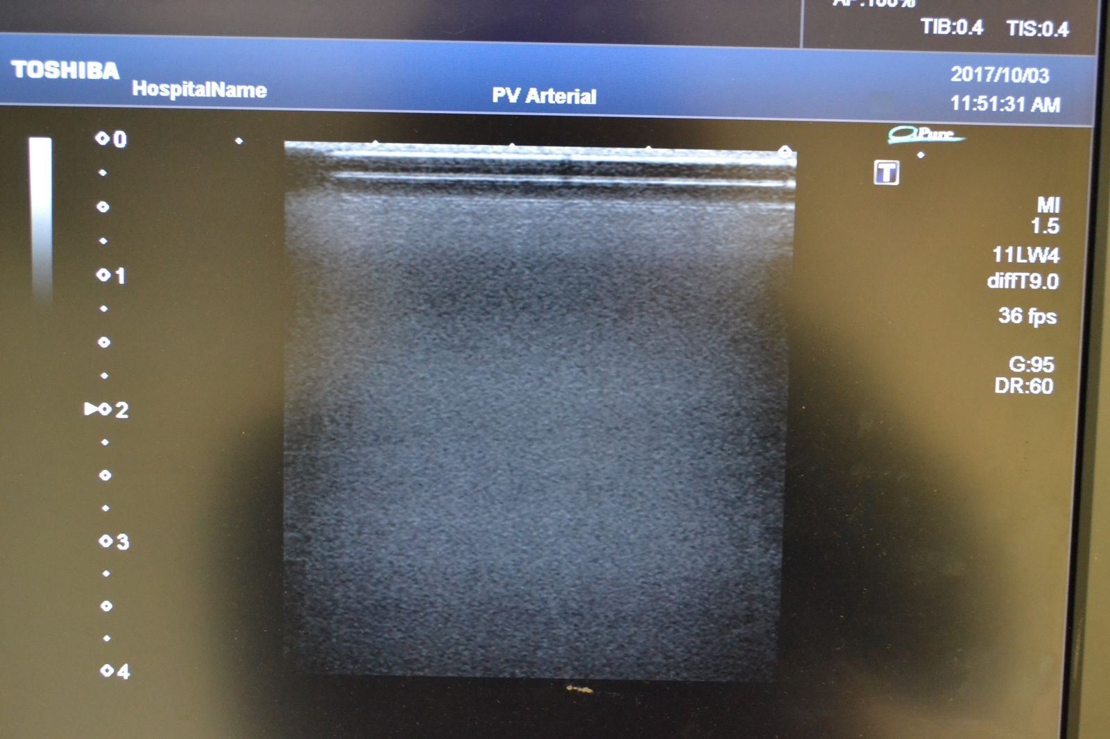 Toshiba Artida PLT-704SBT 11-4.8MHz Linear Ultrasound Transducer Probe J1628 DIAGNOSTIC ULTRASOUND MACHINES FOR SALE
