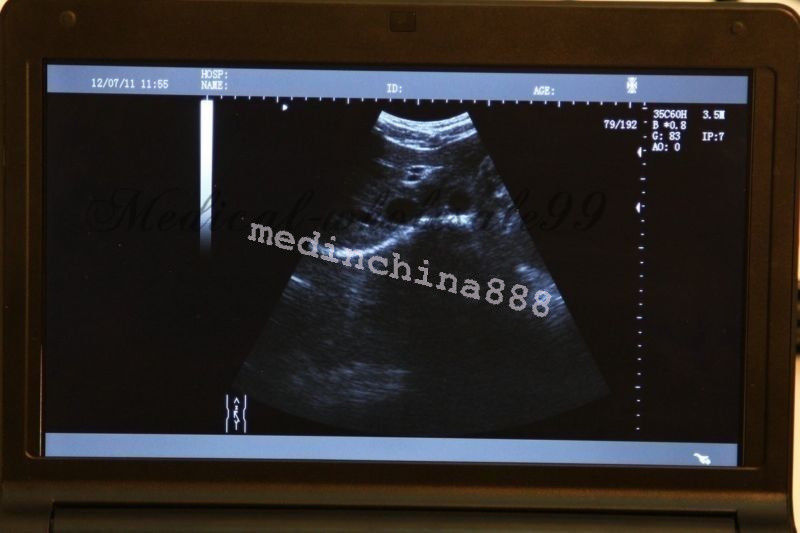 LCD Ultrasound Scanner Machine+Convex + Linear Probe+Sony Printer Best Offer 190891246417 DIAGNOSTIC ULTRASOUND MACHINES FOR SALE
