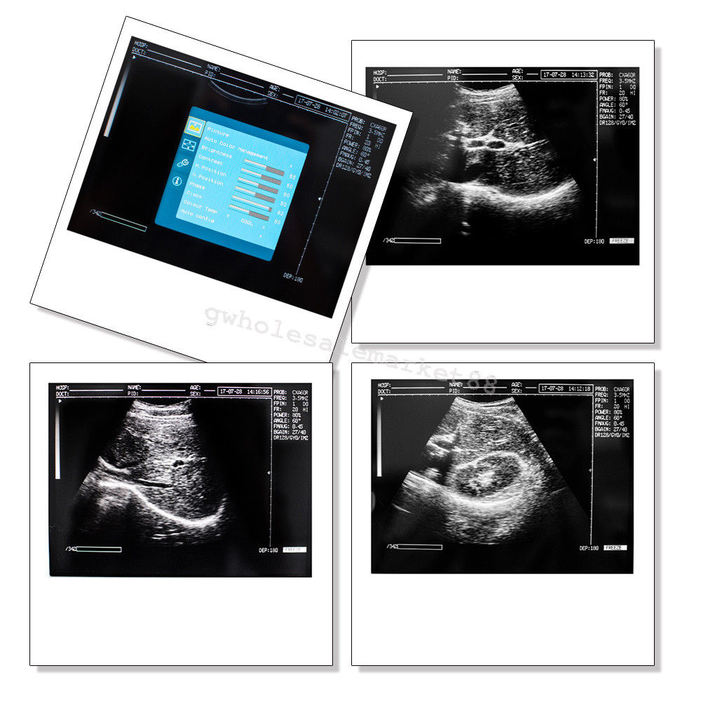 Portable Ultrasound Machine Scanner System Convex probe 3D Software Image Photo 190891045898 DIAGNOSTIC ULTRASOUND MACHINES FOR SALE
